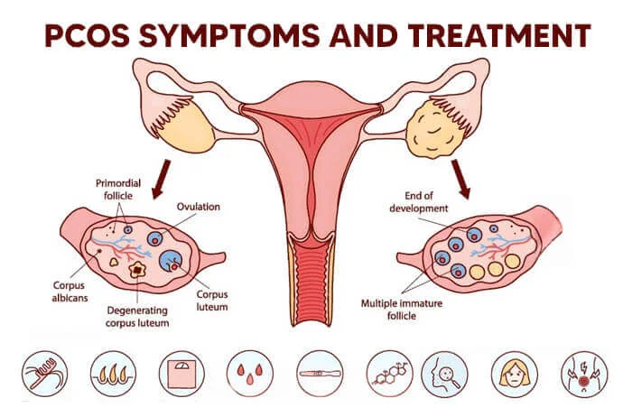 pcos-symptoms-and-treatment